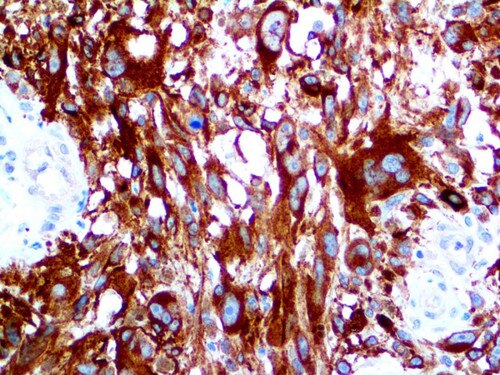IHC of Tyrosinase on an FFPE Malignant Melanoma Tissue